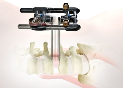 K2M Adds Ravine Neuromonitoring