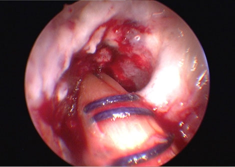 Gender Gap in ACL Tears
