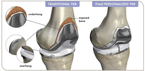 ConforMIS: iTotal G2 Knee System Available