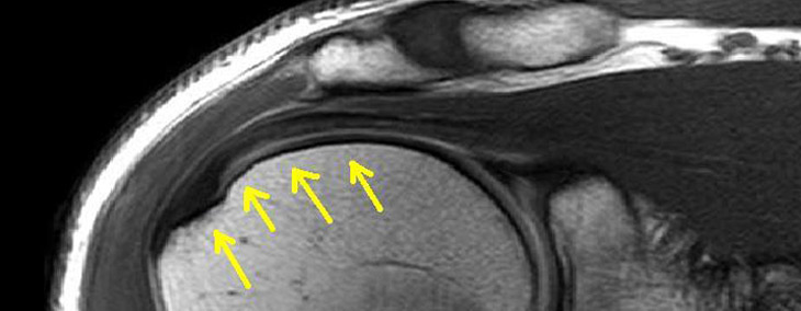 Aging Stem Cells Affect Rotator Cuff Healing? and More…