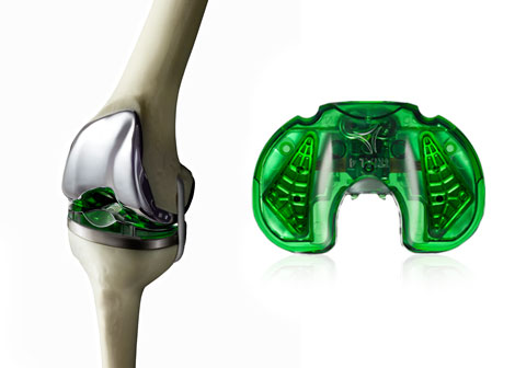 Electronic Sensors Guide Knee Placement