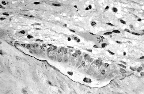Bone Stimulators “Whistleblown”