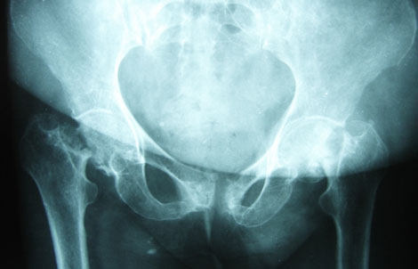 Stem Cells Treat Hip Necrosis