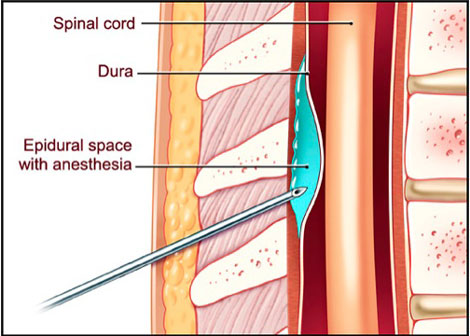 Regional Anesthesia Preferred for Bilateral TKAs