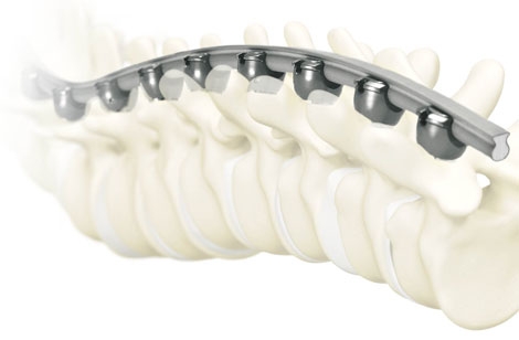 New in Spine: K2M Launches Rail 4D