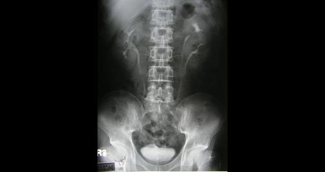 Spinal Motion Preservation: Update and Outlook (Part 2 of 3)