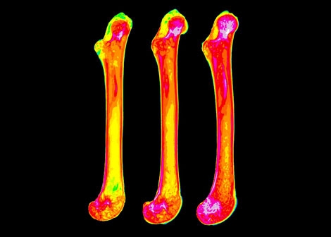 Nine New Genes for Bone Health!