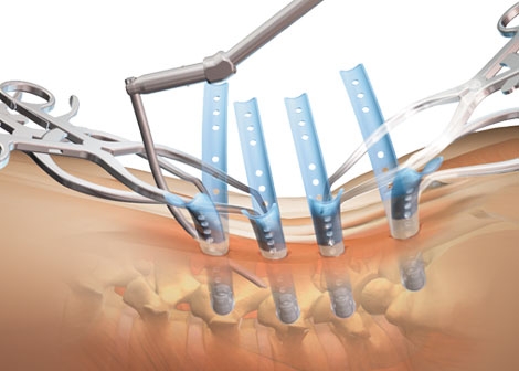 K2M Introduces Retractor System at SRS