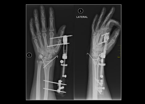 Study Suggests Reversal in Bone Treatment