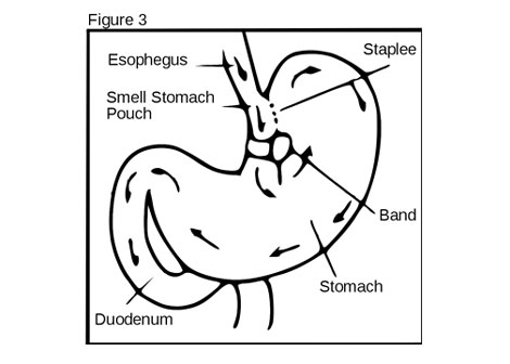 Bariatric Patients: Elevated Fracture Risk?