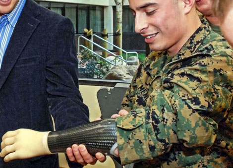 Can Prosthetics Anchor Directly on Bone?
