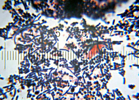 Infection’s Price Tag = $65 Million