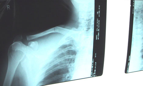 How to Prevent Second Fractures