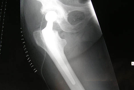 Mega Study Evaluates Joint Patient Outcomes