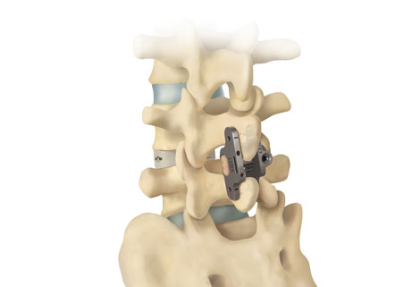 Lanx’s Aspen MIS System Is Granted Patent