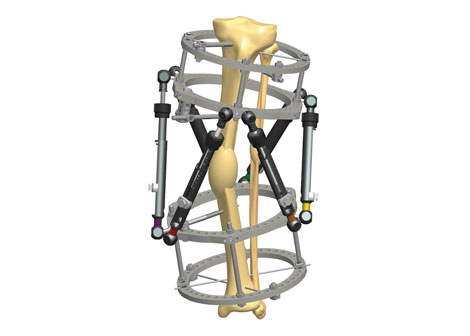 Orthofix Challenges Fixation Market