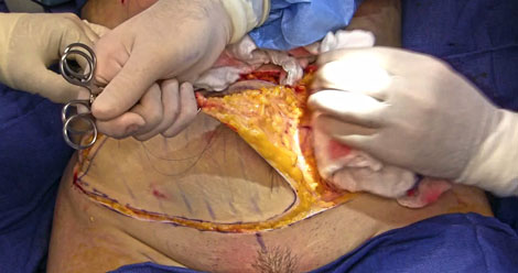 Obesity Heightens Knee Replacement Risk