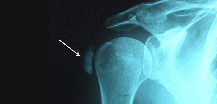 Dramatic Rise in Shoulder Arthroplasty…and More…