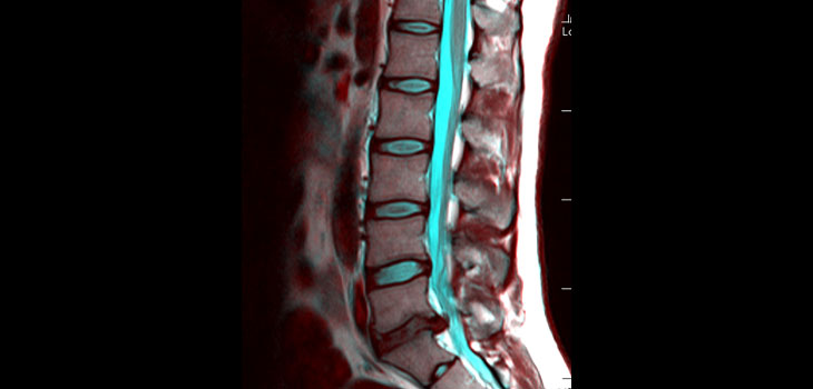 Breakthrough in Arthritis Research