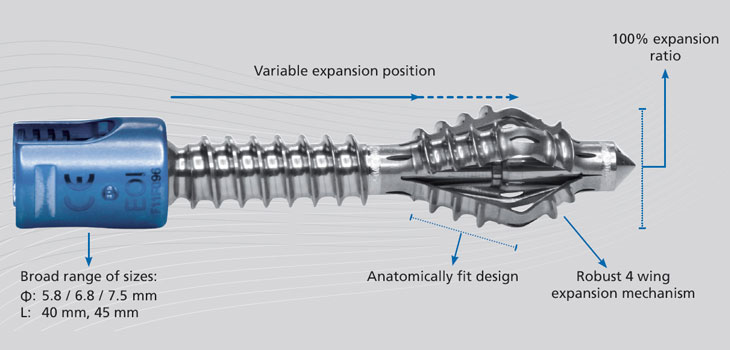 Best Pedicle Screw in the World?