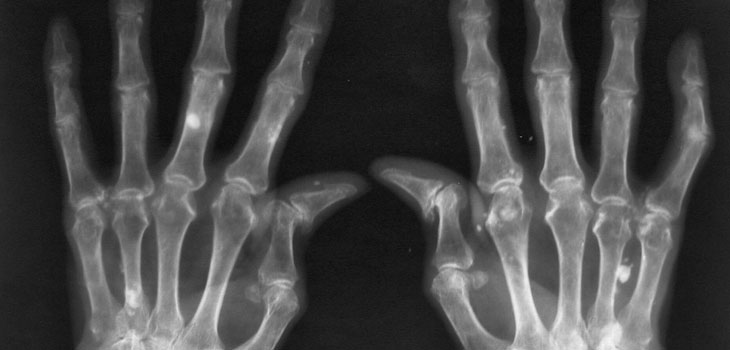 Rheumatoid Arthritis More Problematic Than Osteo