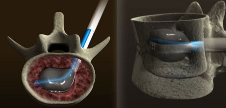 Ascendx Spine Device Granted FDA Clearance
