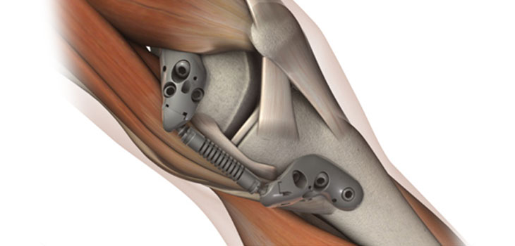 Moximed Implants First KineSpring System