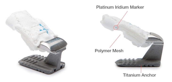 Barricaid Prosthesis Study Enrolls 300th Patient