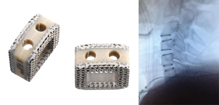 Orthofix Launches Hybrid PEEK/Titanium Spacer