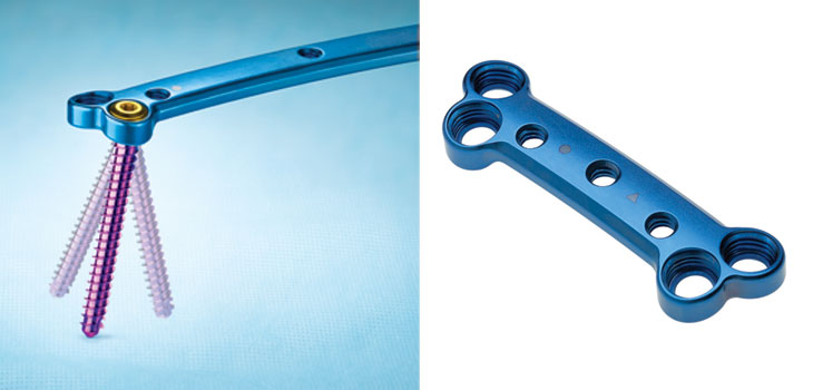 Zimmer Spine Adds First Lateral Plate System
