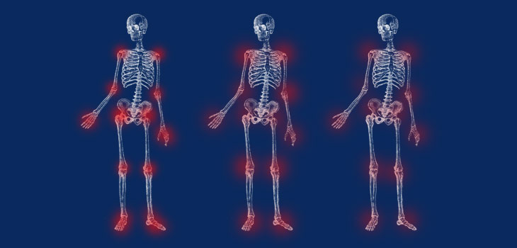 Tofacitinib Improves RA, Inhibits Joint Damage