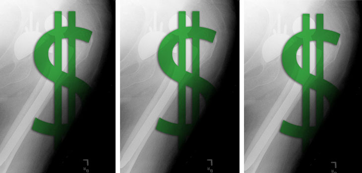 Stryker Metal-on-Metal Costs Could Reach $390 Million