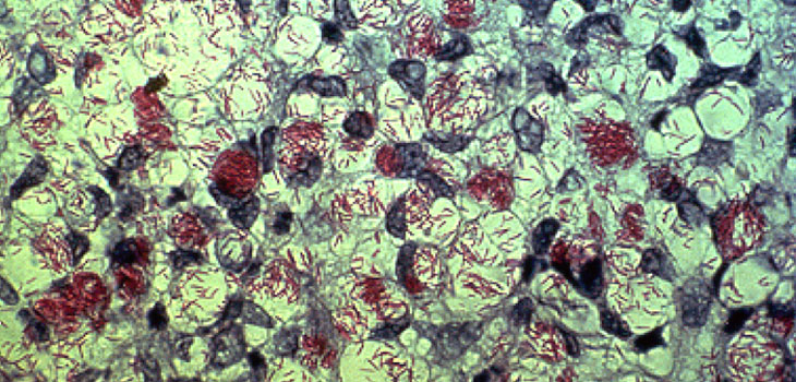 Leprosy Bacterium Reprograms Stem Cells