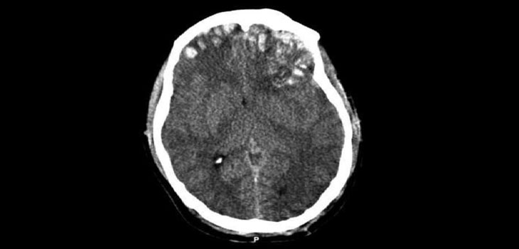 NFL Brains Show Signs of CTE