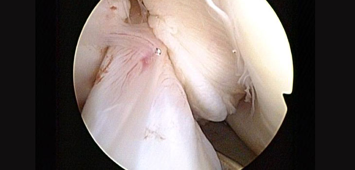 Women 3X More Likely to Rupture ACL