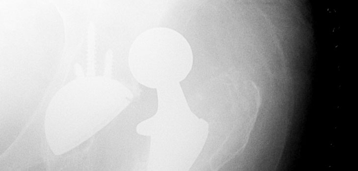 Hip Revision Risk Factors Identified