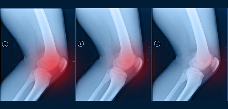 Remarkable New Technique for Eliminating Knee Pain, Escalation in Periprosthetic Fractures! …and More