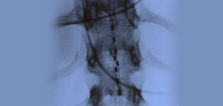 Spinal Cord Injuries: New Information