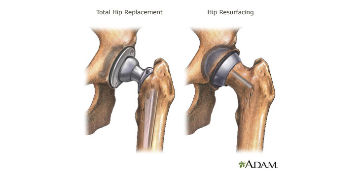 Metal-on-Metal Hips to Require PMA