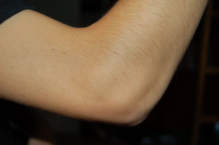 Augment for Tennis Elbow: BioMimetic Commences Enrollment