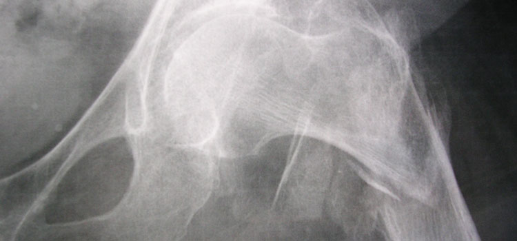 Men, Bone Fracture, and Prostate Cancer