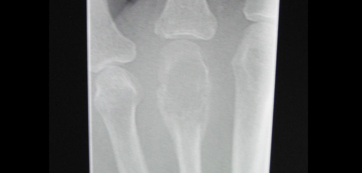 Cancer Drugs Increase Risk of Bone Tumors?