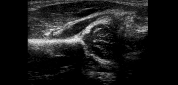 Ultrasound Blast Speeds Bone Healing