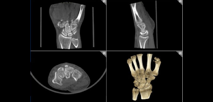 New Scanner Reveals Extremity Fractures