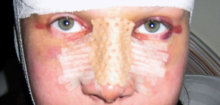 Stem Cells Grow New Nose