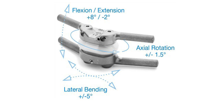 The Return of TOPS Spinal Implant