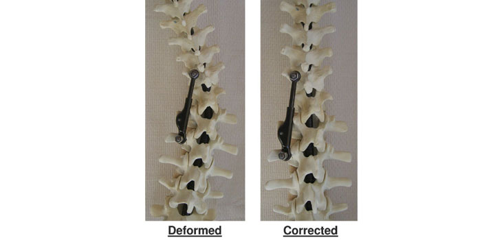 Simplified Scoliosis Treatment Awarded CE Mark