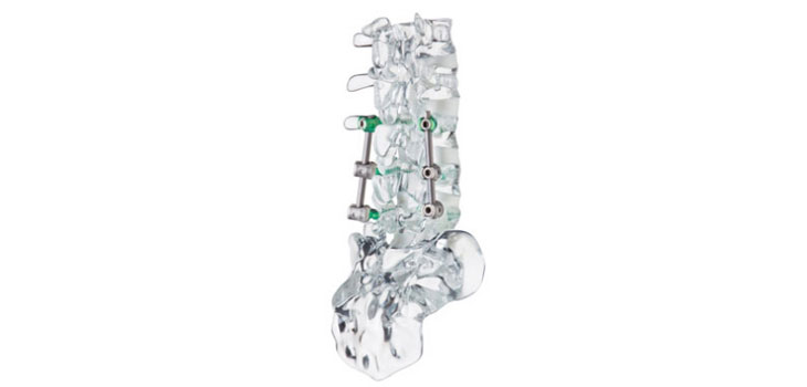 ulrich medical Offers New Spinal Implant