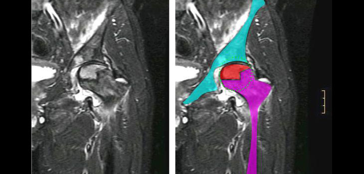 New Study Looks at Osteonecrotic Cell Interactions…and much more