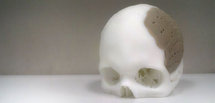 Major First! FDA Grants First 3D Printed Implant Clearance